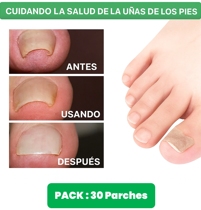 NailRelief™ – Pack por 3 cajas Corrector para Uñas Encarnadas